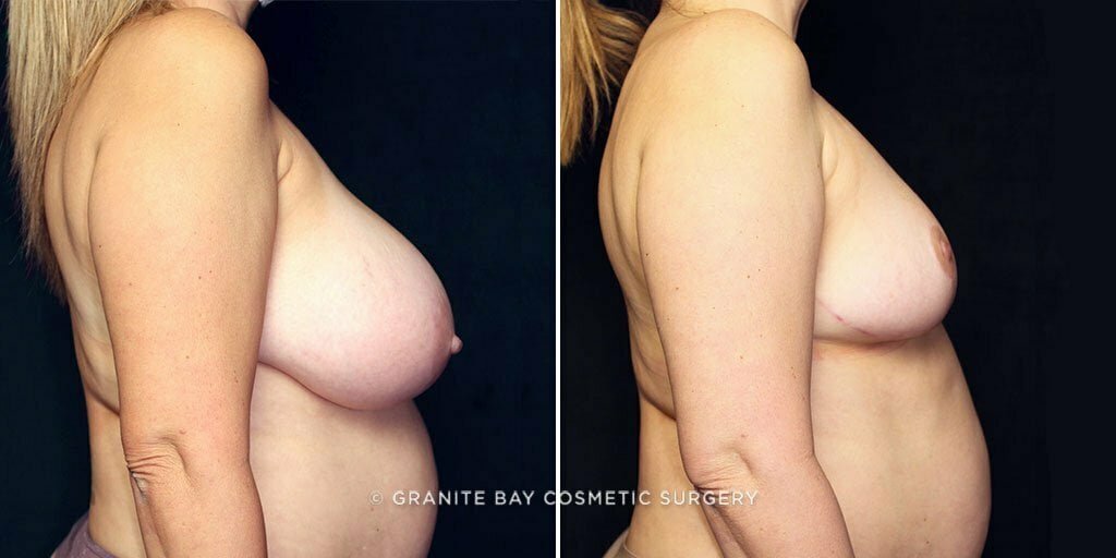 breast-reduction-25674c-gbc