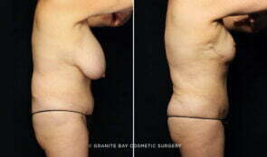 liposuction-posterior-trunk-23548c-gbc