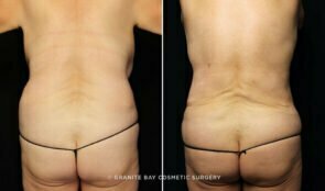liposuction-posterior-trunk-23548d-gbc