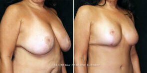 mmo-breast-lift-implant-22133b-gbc