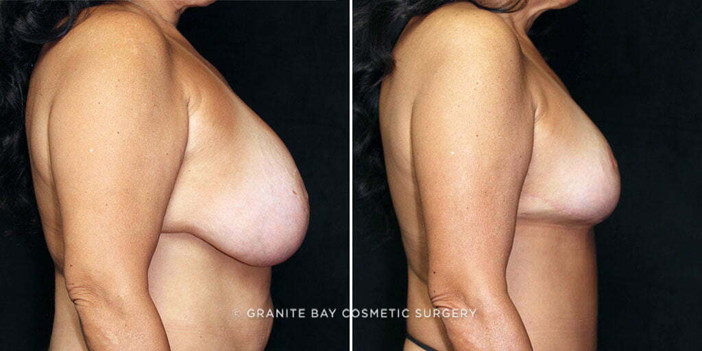 mmo-breast-lift-implant-22133c-gbc