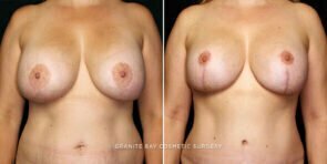 mmo-breast-lift-implants-10821a-gbc