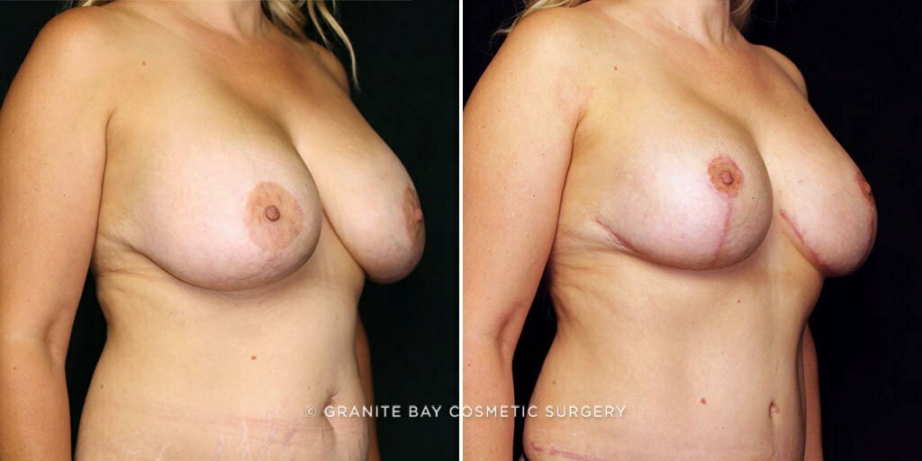 mmo-breast-lift-implants-10821b-gbc