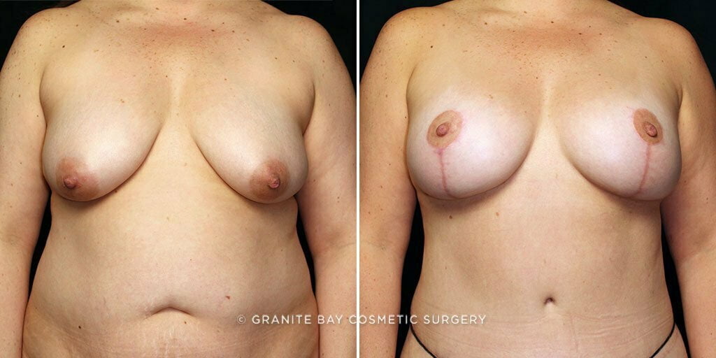 mmo-breast-lift-implants-25619a-gbc