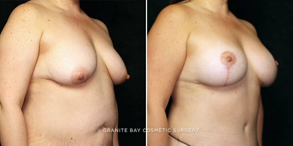 mmo-breast-lift-implants-25619b-gbc