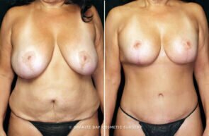 mommy-makeover-breast-lift-implant-tummy-tuck-22133a-gbc