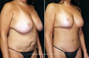 mommy-makeover-breast-lift-implant-tummy-tuck-22133b-gbc