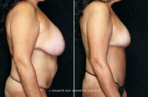 mommy-makeover-breast-lift-implant-tummy-tuck-22133c-gbc