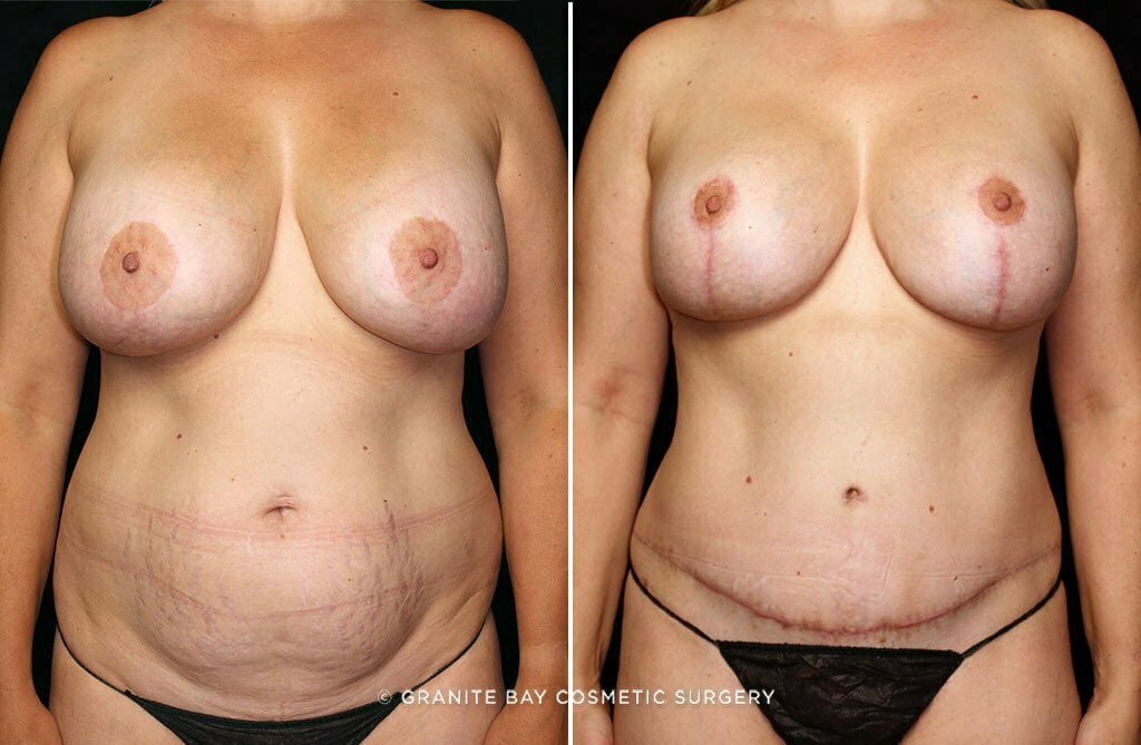 mommy-makeover-breast-lift-implants-tummy-tuck-10821a-gbc