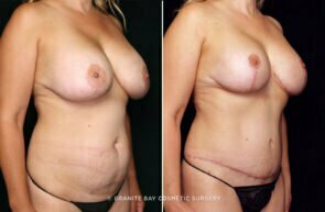 mommy-makeover-breast-lift-implants-tummy-tuck-10821b-gbc