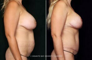 mommy-makeover-breast-lift-implants-tummy-tuck-10821c-gbc