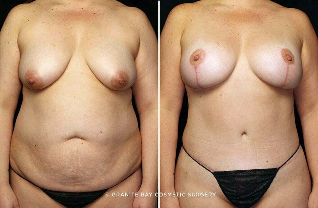 mommy-makeover-breast-lift-implants-tummy-tuck-25619a-gbc
