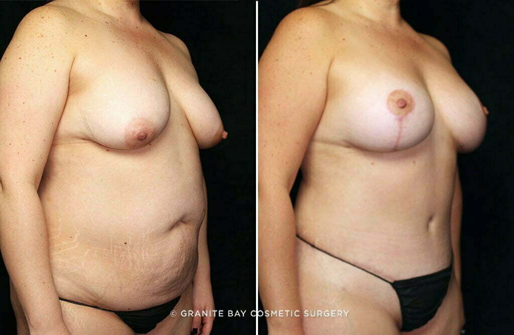 mommy-makeover-breast-lift-implants-tummy-tuck-25619b-gbc