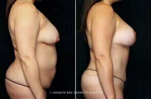 mommy-makeover-breast-lift-implants-tummy-tuck-25619c-gbc