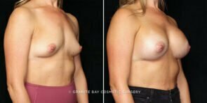 breast-augmentation-25697b-gbc