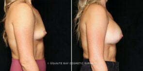 breast-augmentation-25697c-gbc