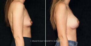 breast-augmentation-25919c-gbc