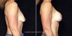 breast-lift-implants-26125c-gbc