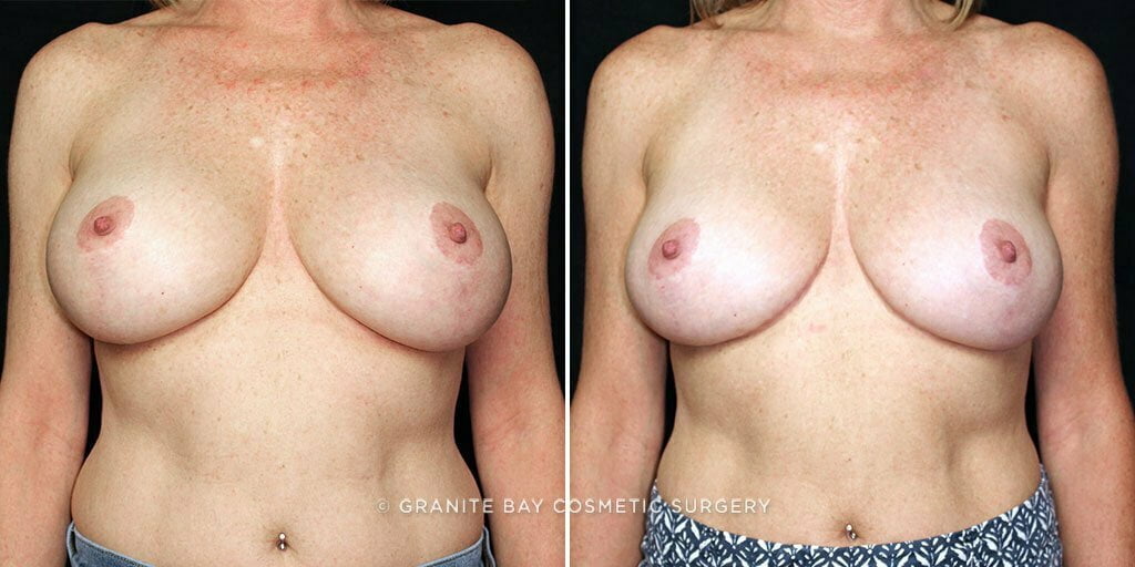 Breast Revision Implant Exchange