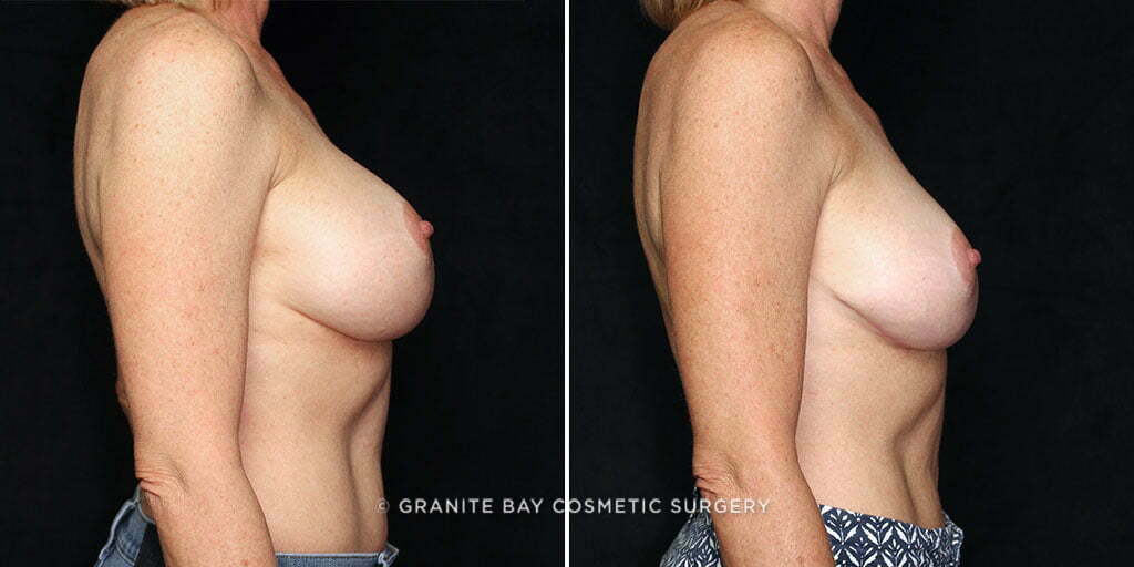 breast-revision-downsize-26389c-gbc