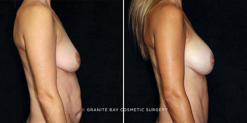 mmo-breast-augmentation-23265c-gbc