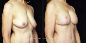 mmo-breast-lift-implants-22831b-gbc