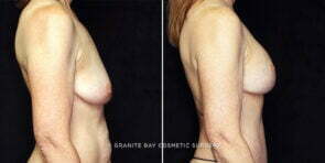 mmo-breast-lift-implants-22831c-gbc