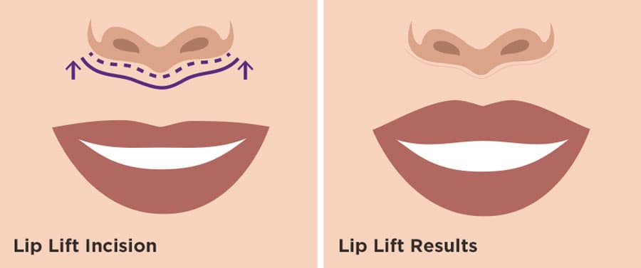 Granite Bay Cosmetic Lip Lift Incision Illustration