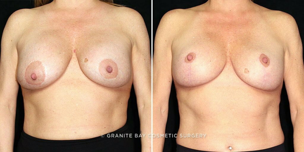 Breast Implant Exchange with Lift