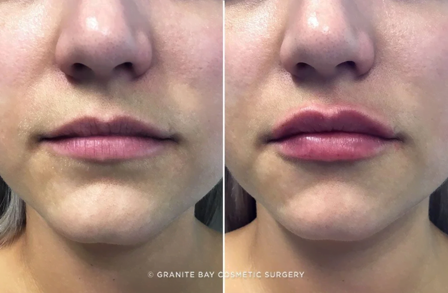 These photos show our patient’s beautiful non-surgical lip augmentation results. 