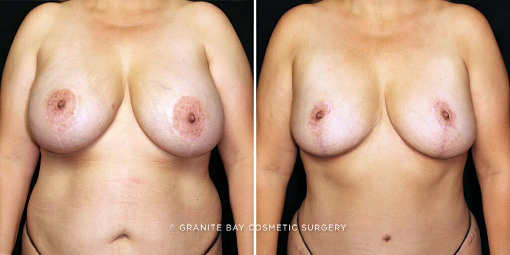 Breast Implant Exchange