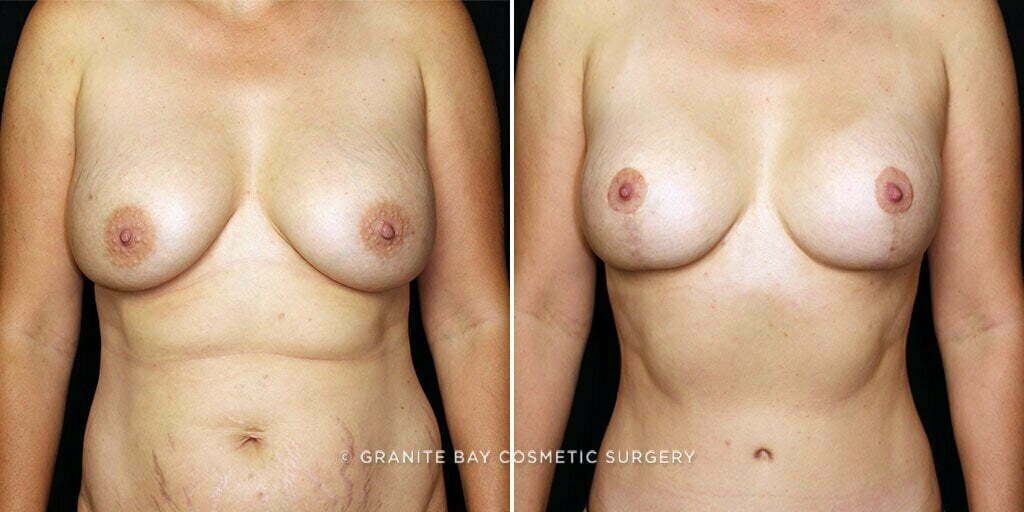 Breast Implant Exchange with Lift