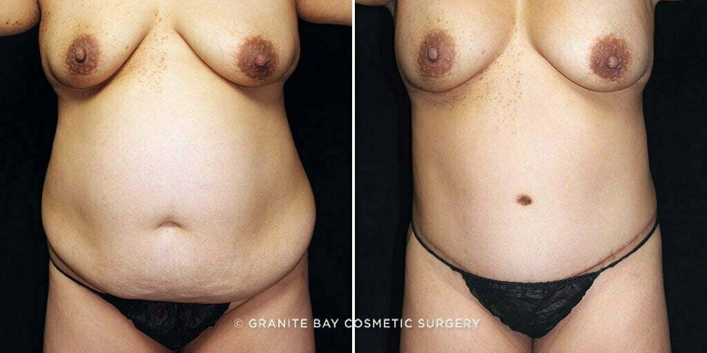 Tummy Tuck