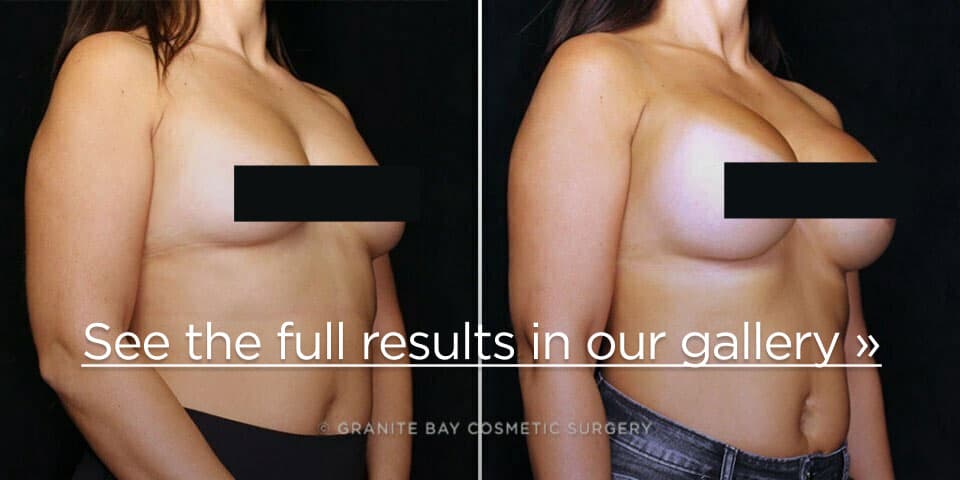 Granite Bay Cosmetic Surgery real patient before and after breast augmentation with implants
