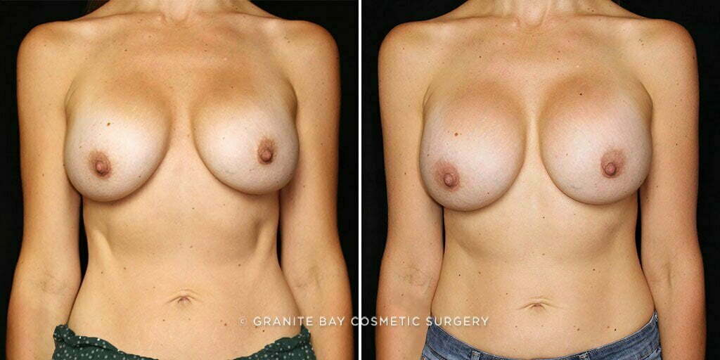 Breast Implant Exchange