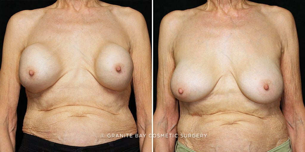 Breast Implant Exchange