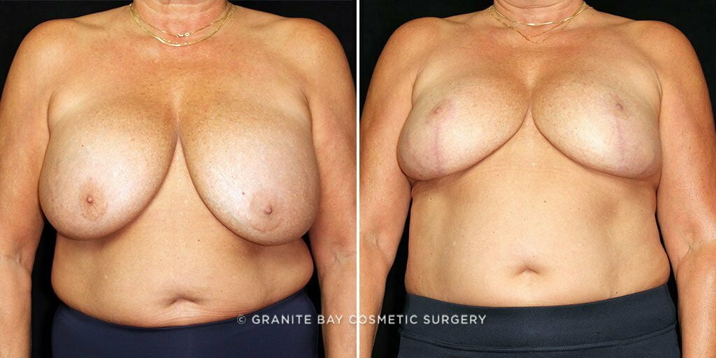 Breast Implant Exchange with Lift