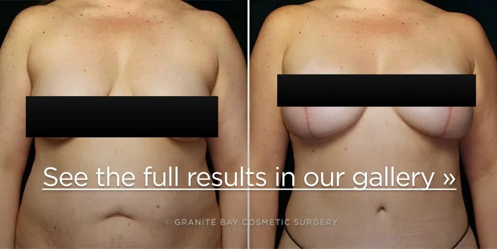 Before and after breast augmentation, 6 weeks post op : r