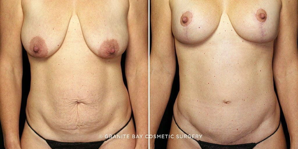 Tummy Tuck