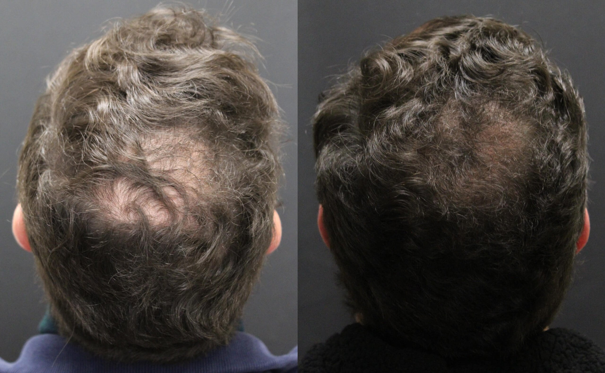 Photo of a patient before and after hair restoration treatment.