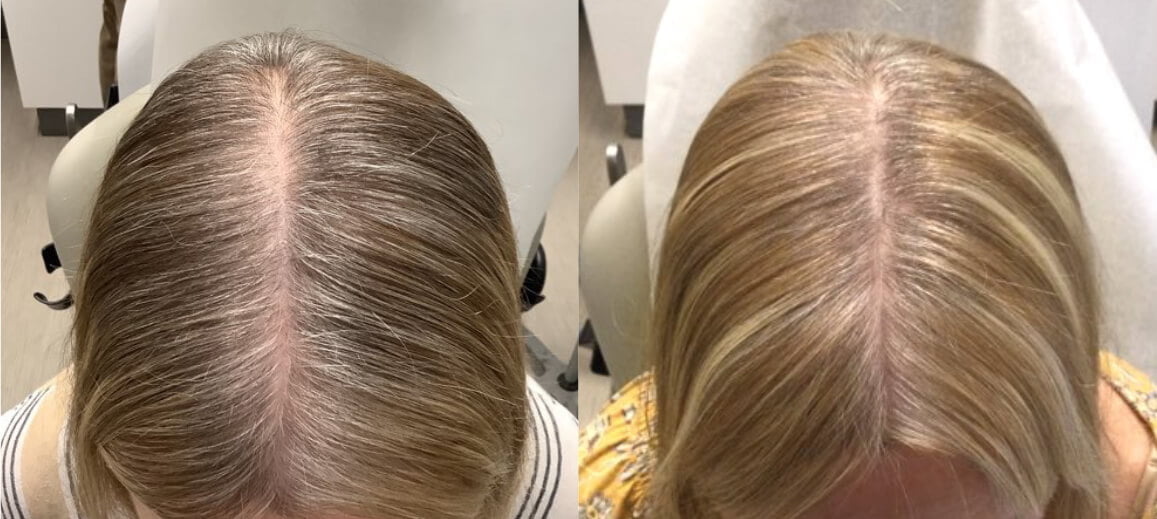 Photo of a patient before and after hair restoration treatment.