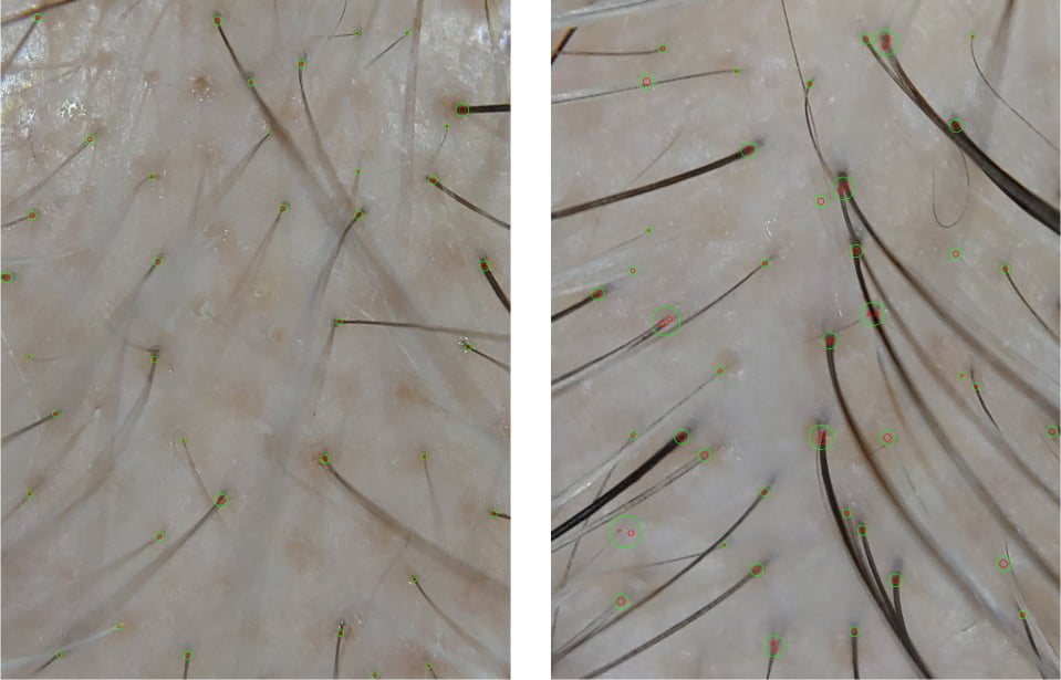 Alt text: Photo of a patient’s scalp before and after hair restoration treatment.