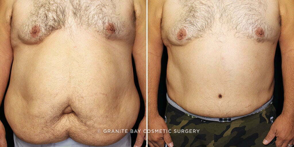 Tummy Tuck with Liposuction