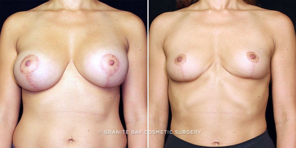 Breast Implant Exchange