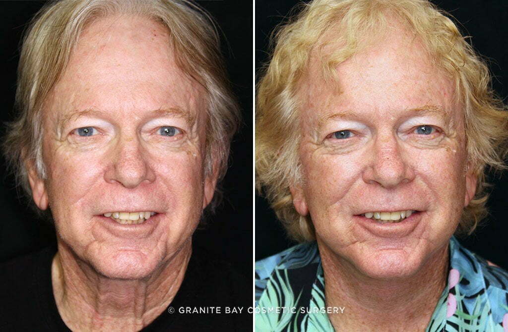 Facelift with Neck Lift