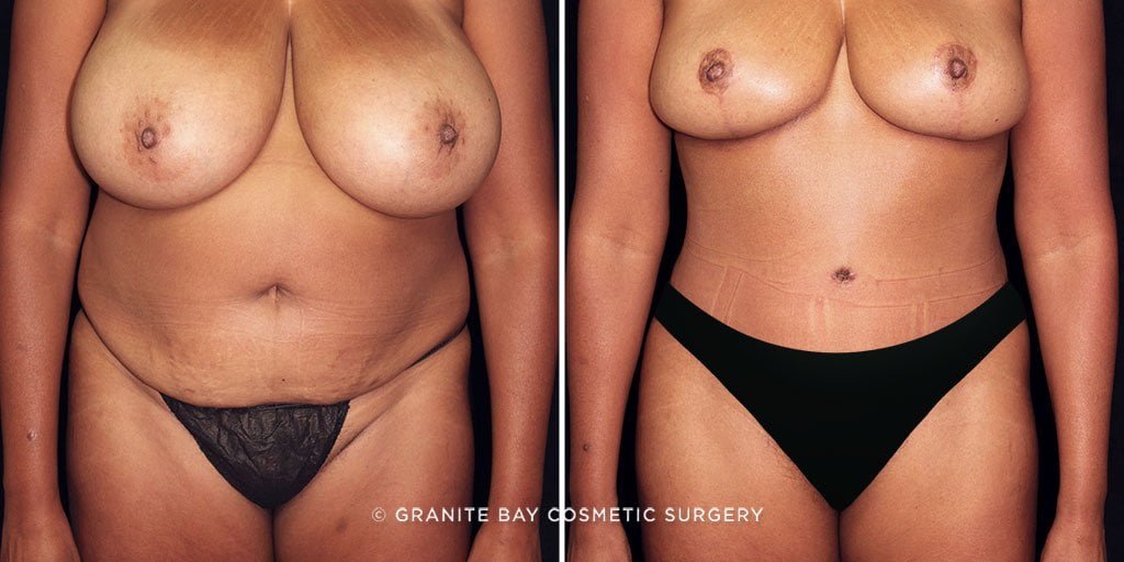 MMO Tummy Tuck