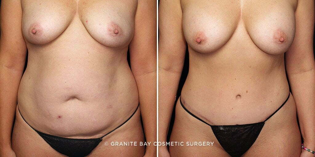 MMO Tummy Tuck