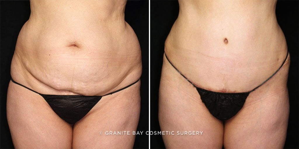 Tummy Tuck with Liposuction