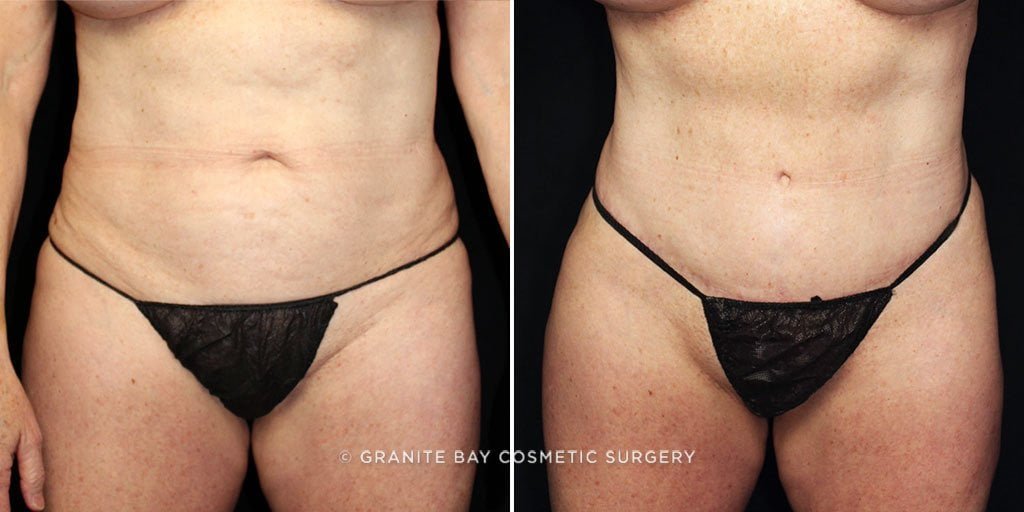 Tummy Tuck