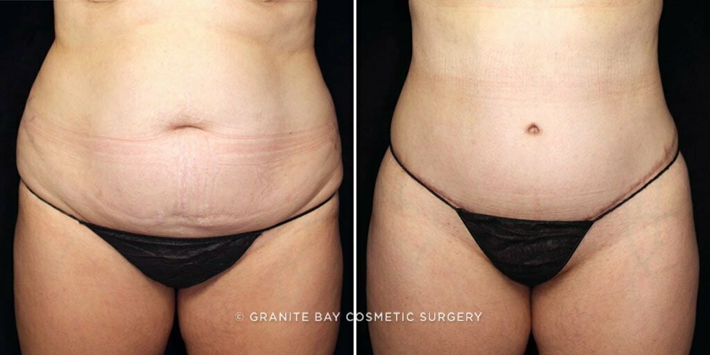 Tummy Tuck with Liposuction